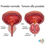 foto di prostata